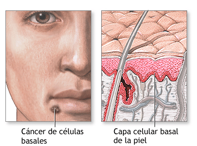 Cirugia de Cancer de Colon en Leon Gto 5