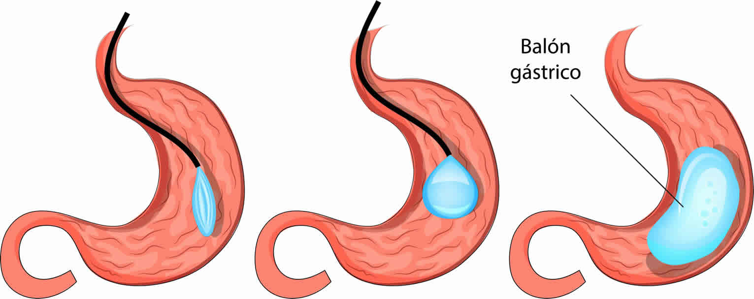 Balon Gastrico en Aguascalientes 3