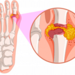 IMAGENARTRITIS