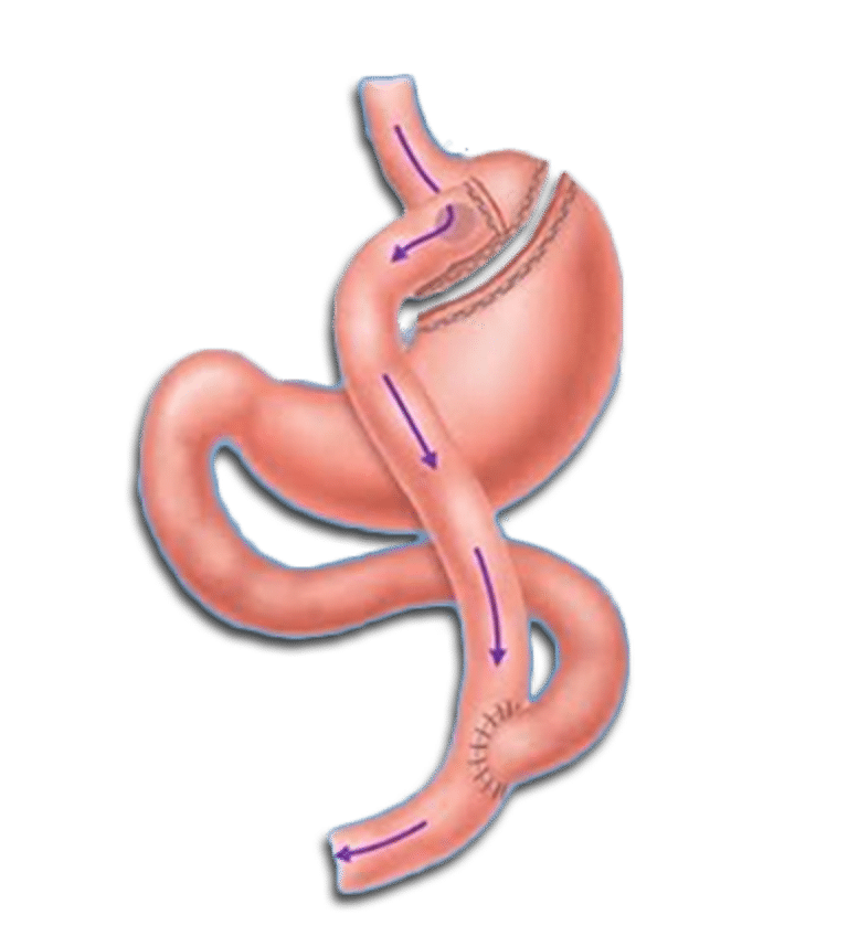 Balon Gastrico en Aguascalientes 6