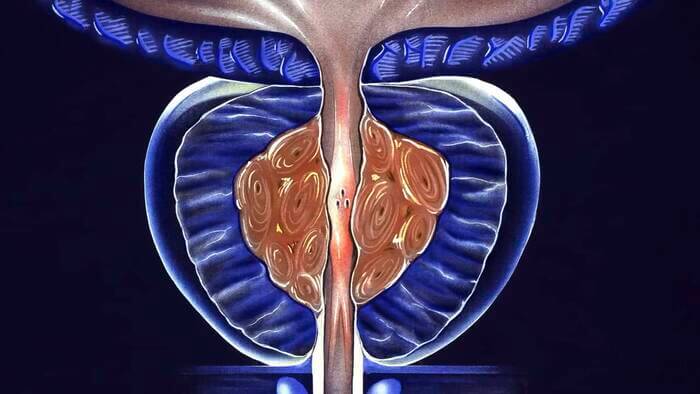 Cirugia de prostata con laser en Tonala 6