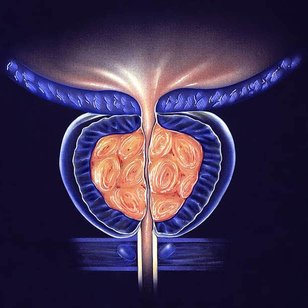 Cirugia de prostata con laser en Tonala 4